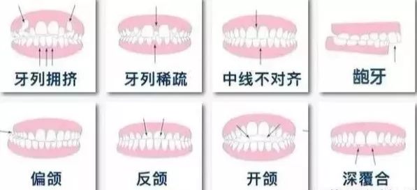 牙齿矫正隐形牙套价格,你的牙花了多少钱