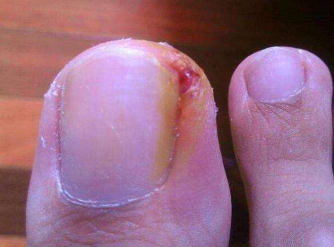 灰指甲加脚气加甲沟炎用什么泡脚,灰指甲脚气甲沟炎鸡眼挂什么科