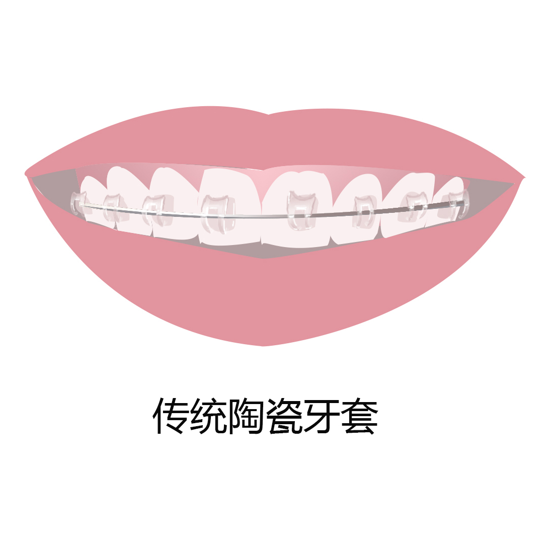 现在牙套有几种哪种好,牙套哪种最好