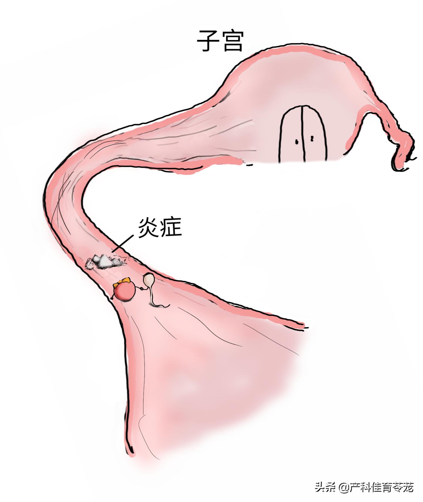 跑步能预防宫外孕吗,试管怎么预防宫外孕