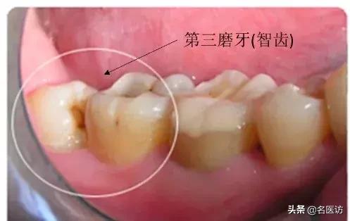 拔智齿有什么禁忌吗,拔智齿有什么禁忌