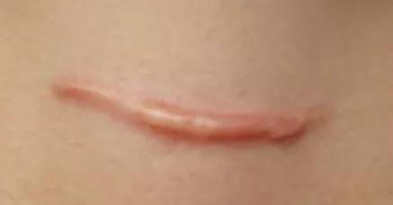 欣奕除疤凝胶对疤痕体质有效果吗,疤痕形成后用芦荟能除疤吗