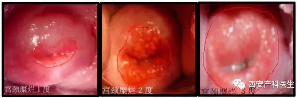 宫颈糜烂会导致不孕吗,专家说宫颈糜烂需要治疗吗