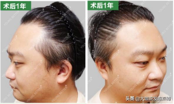 从后脑勺往头顶慢慢脱发,额前脱发植发效果如何