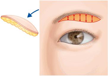 提眉术的优点及缺点,提眉术怎么才算做得好
