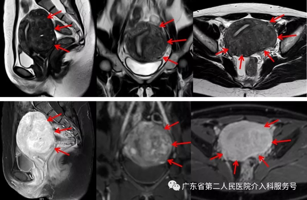 经皮穿刺肿瘤物理消融术,介入治疗痛经