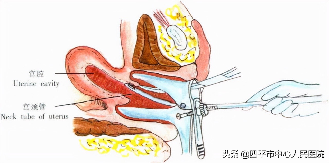 绝经后阴道流血的症状,可出现绝经后阴道流血症状的疾病