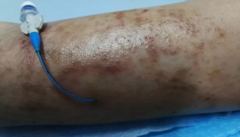 picc敷贴旁边长了小水泡,picc导管贴膜维护教学视频