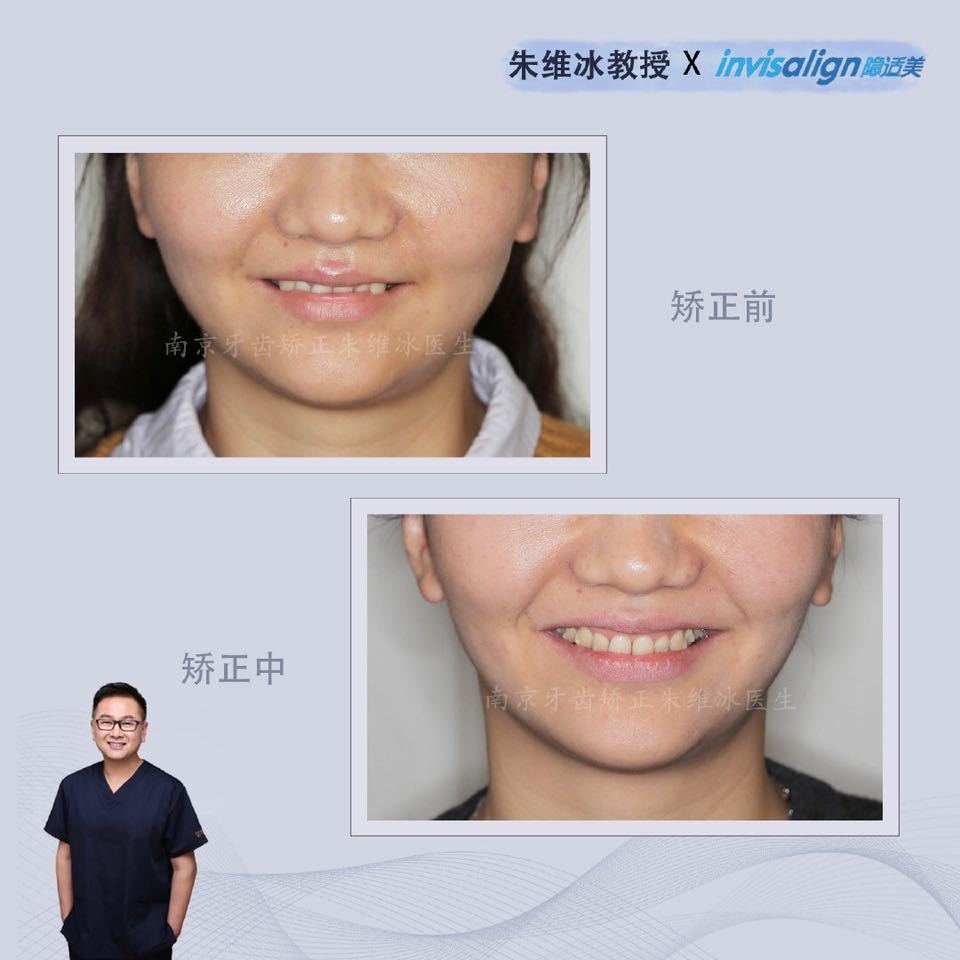 隐适美牙齿拥挤矫正真实案例,南京朱维冰