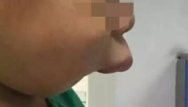 牙龈反复鼓包流脓是牙齿坏了吗,一上火牙龈就鼓包