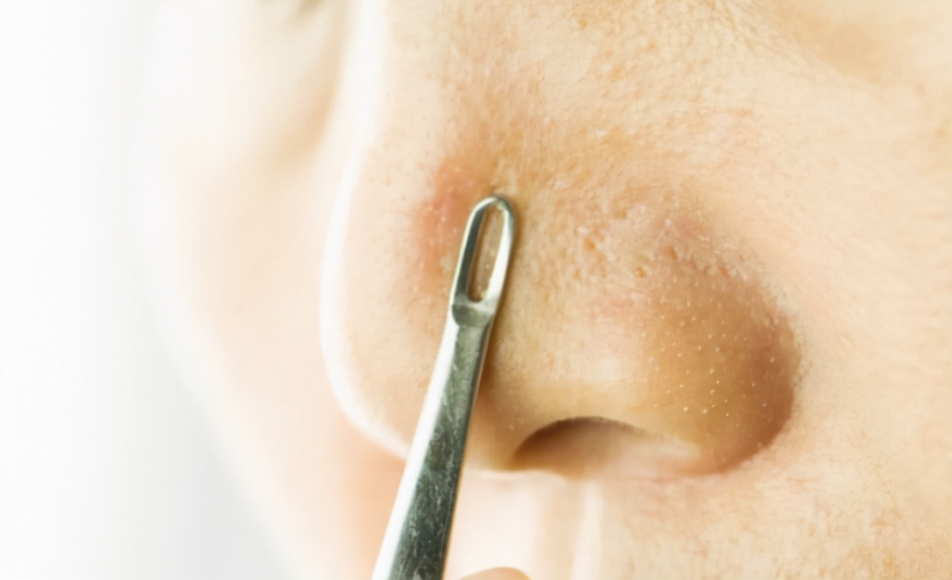 去黑头为什么黑头越来越多,长了黑头到底能不能挤