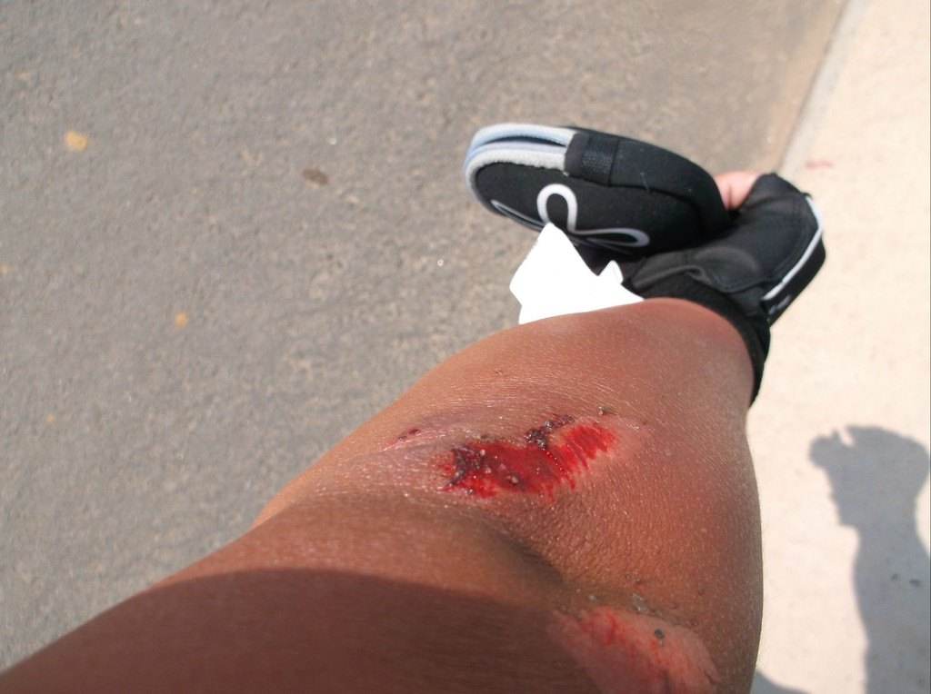 小磕小碰、摔伤烧伤在所难免，不想去医院，在家如何安全处理？