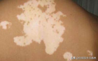 得了白癜风护理时要小心哪些误区,得了白癜风护理时要注意哪些误区