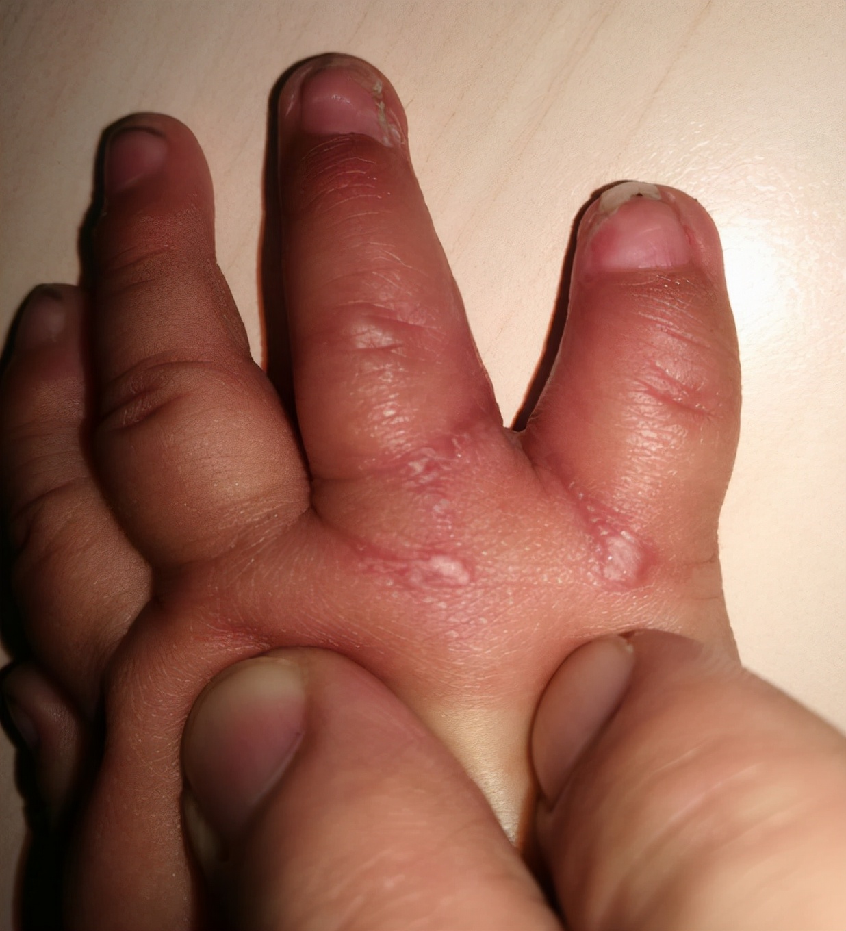 并指畸形免植皮案例,并指畸形