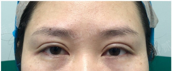 全切双眼皮提肌失败还能修复吗,什么是失败的双眼皮