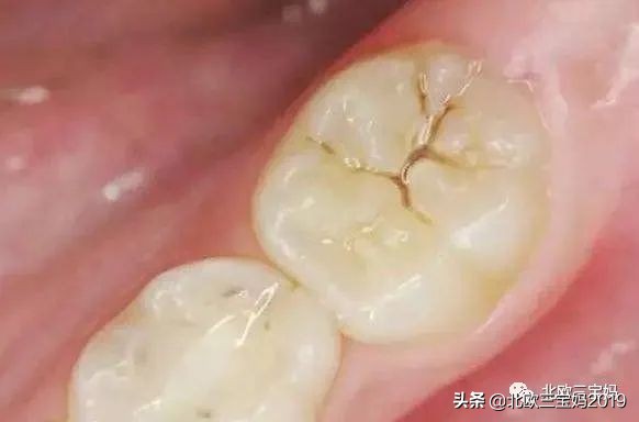 5岁小孩打全麻治蛀牙有影响吗,3岁孩子全麻风险大吗