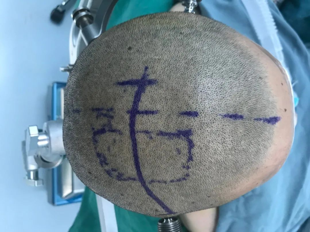 25岁男子被罕见病折磨19年,男子被精神病折磨20年后续