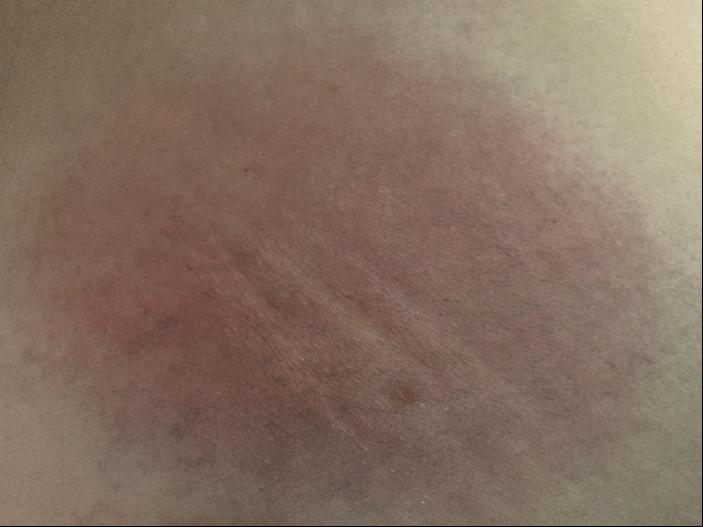 胰腺癌100例分享,治疗胰腺癌晚期的最新技术突破