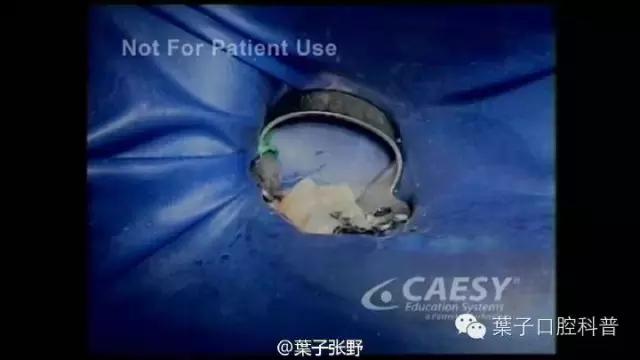 牙龈反复鼓包流脓是牙齿坏了吗,一上火牙龈就鼓包