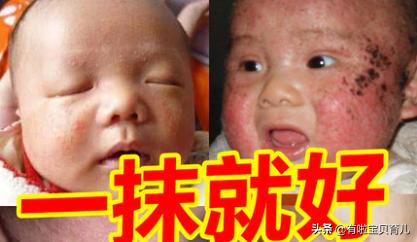 哪种湿疹膏最好用又安全,最好用的湿疹膏