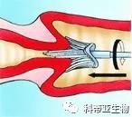 宫颈癌筛查是取哪些东西,宫颈癌筛查需要准备什么