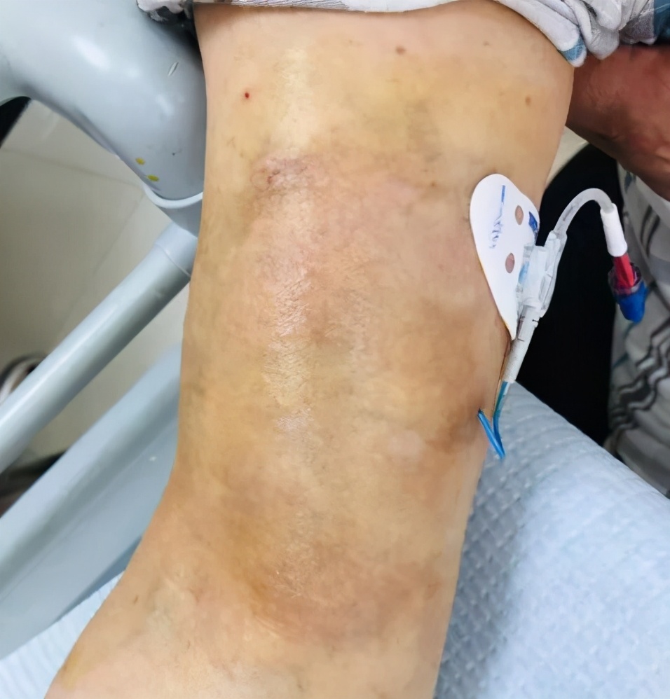 picc置管敷贴皮肤痒如何处理,picc置管防过敏贴膜进口