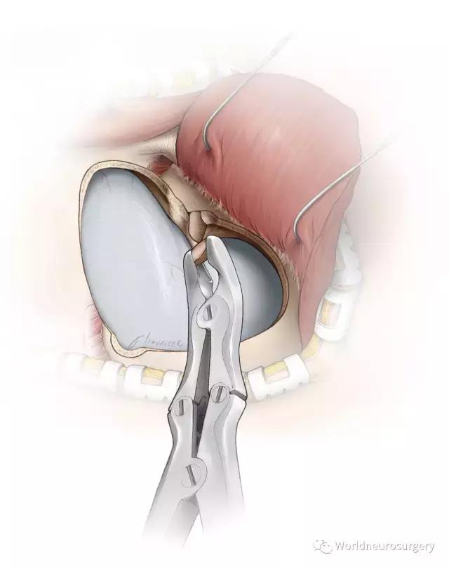 翼点入路的开颅要点,翼点开颅详解图