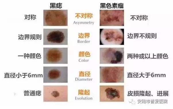 一颗痣的隐患,一颗痣的烦恼