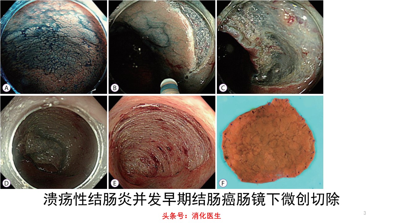 溃疡性结肠炎导致肠癌,溃疡性结肠炎与肠癌症状