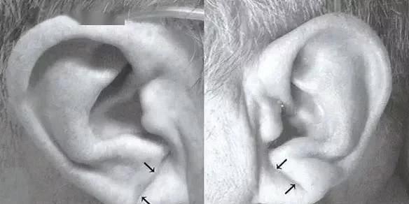 耳朵上血管明显怎么回事,冠心病耳朵褶皱一般在左耳吗