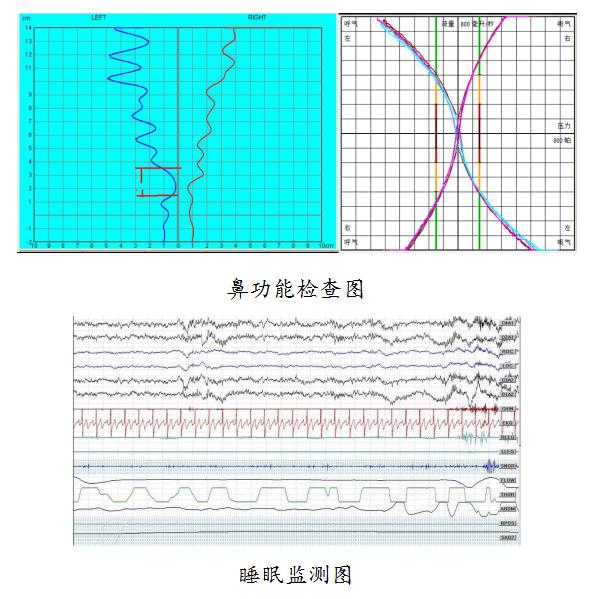 警惕睡眠杀手鼾症,沉默的杀手指的是什么疾病