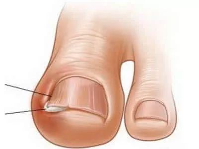 生活小常识脚趾甲,指甲小知识大全