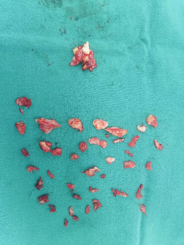 肘关节僵硬手术松解后一直有积液,肘关节僵硬异位骨化必须做松解吗