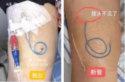 护士picc导管维护,护士picc相关知识薄弱