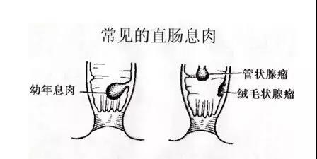 两个肉球脱出是什么痔疮,掉出肉球是痔疮吗