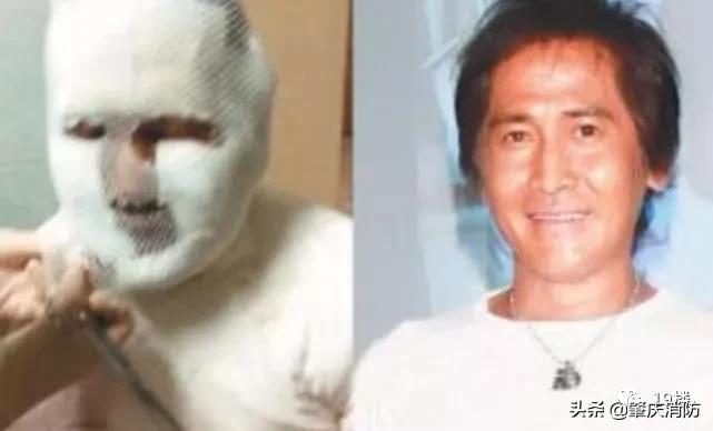 女子拔火罐被烧伤后续,明星拔火罐烧伤事件