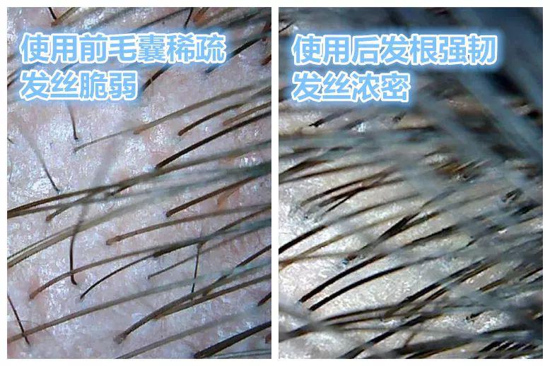 去头屑去螨虫哪个洗发水最有效,去头屑去螨虫用哪个洗发水最有效