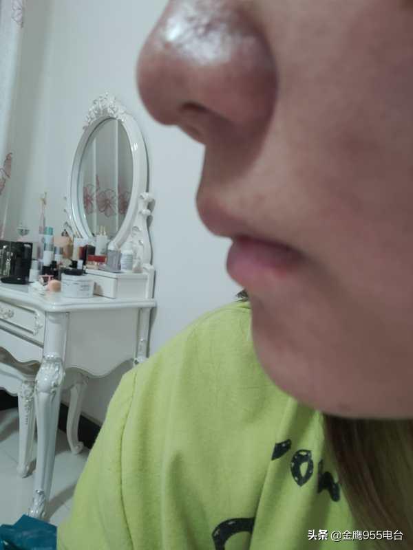 隆鼻后变成朝天鼻,隆鼻后成了朝天鼻