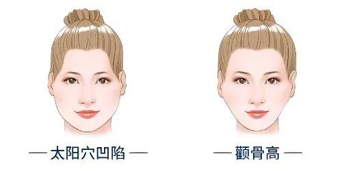 韦敏颧骨手术怎么样,如何判断高颧骨和颧弓外扩