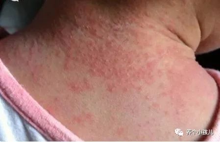宝宝出现湿疹的原因和护理措施,高烧湿疹的症状及治疗方法