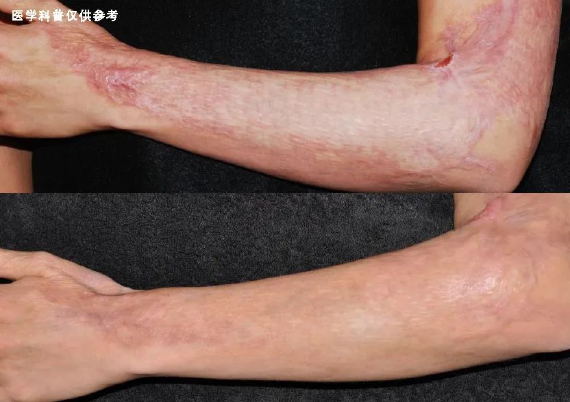 烧烫伤疤痕去除最好办法,烧烫伤疤痕怎么修复