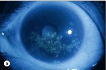 干燥综合征是什么样的症状,干燥综合征是什么样的