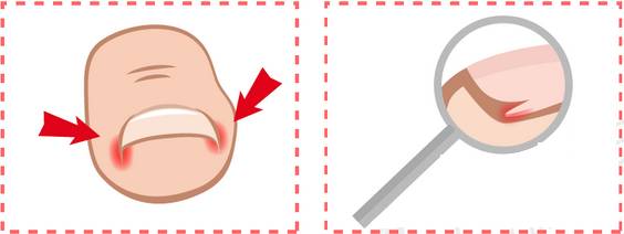 脚指甲注意事项,脚指甲上面的肉扎着疼