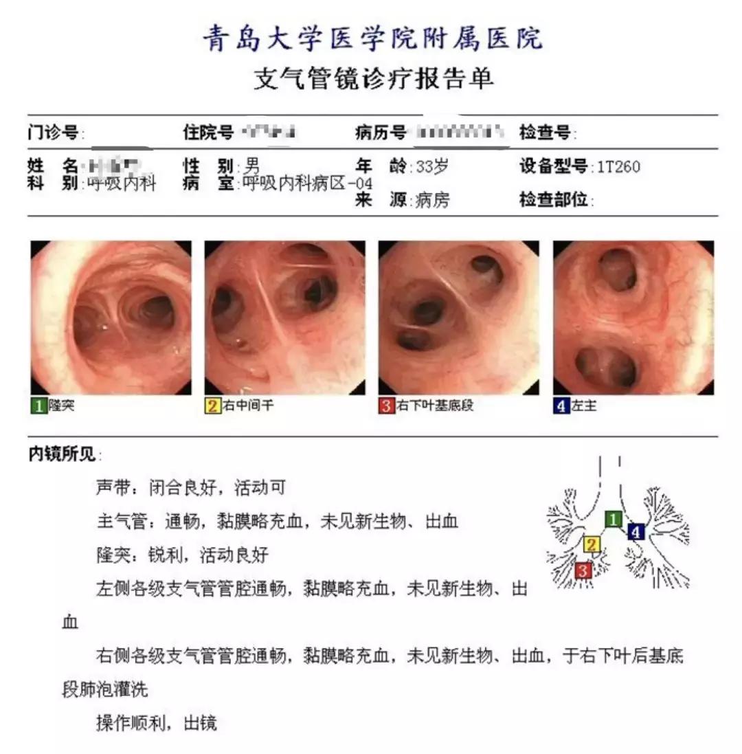 肺纤维化病例,肺纤维化手指甲发紫还能活多久