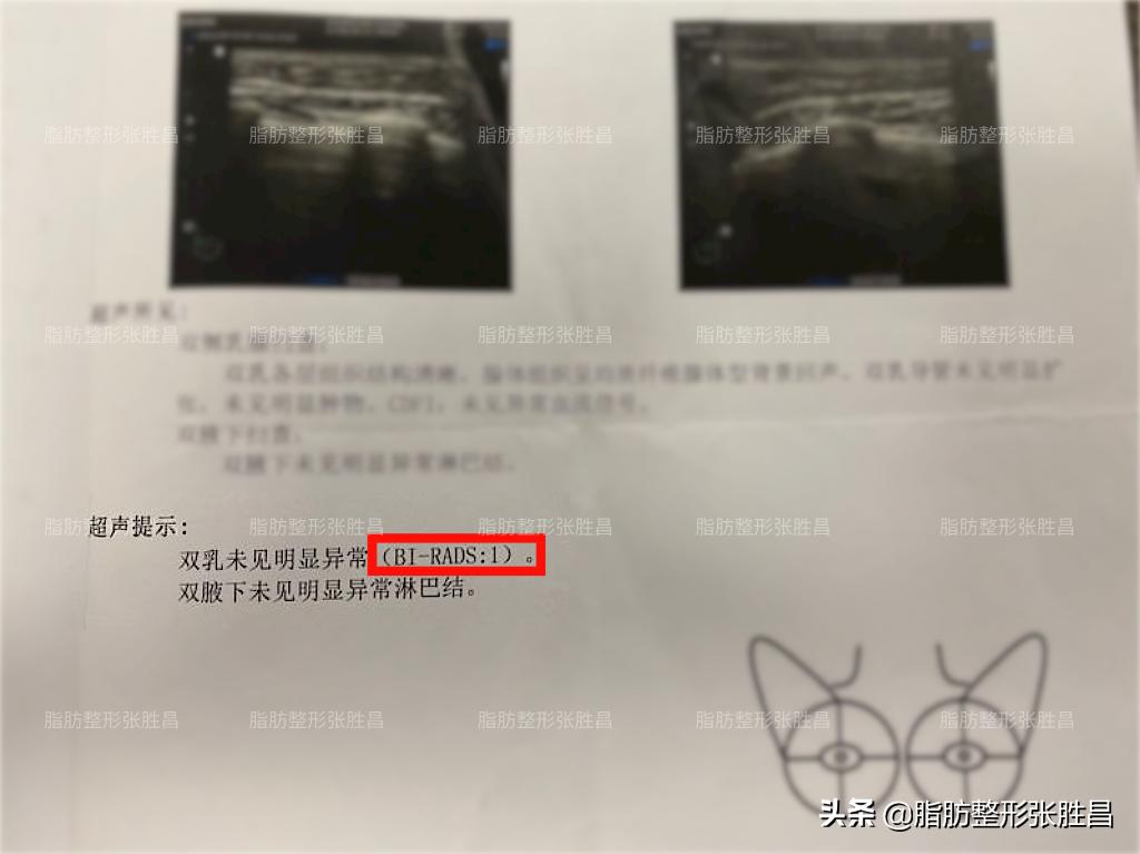 乳腺癌自体脂肪隆胸两年后的忠告,自体脂肪隆胸后乳腺钙化