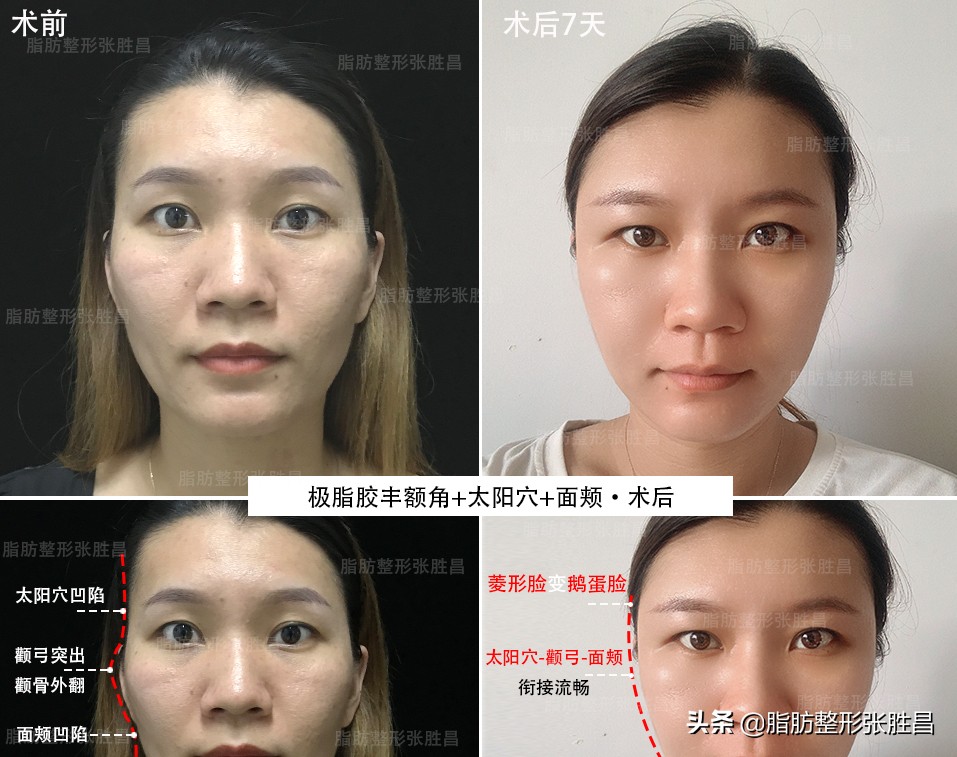 一块骨头把温柔脸变凶脸？她颧骨高如山，不经磨骨之痛却收获了美