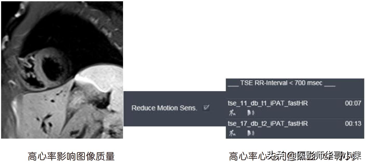 心脏mr增强扫描讲解,磁共振心脏扫描标准切面