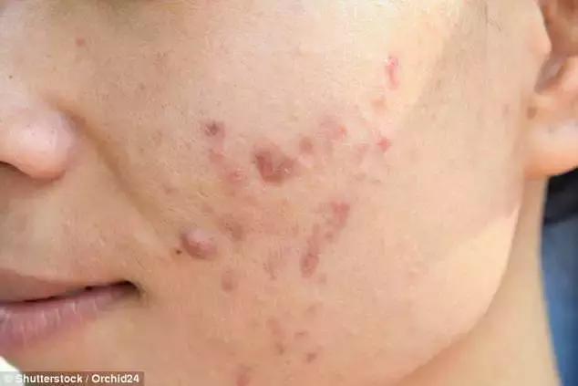 老外有多迷恋拔火罐,外国人吐槽中国拔罐