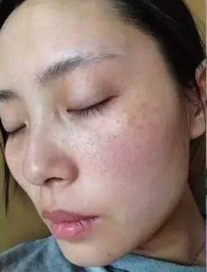 怎么改善斑点和暗黄,褐青色斑和雀斑哪个容易治疗