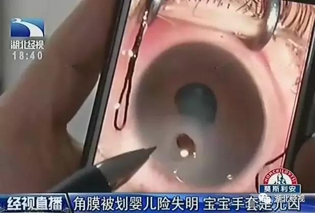 2岁宝宝眼角破了一个口子,眼角膜破了洞怎么办